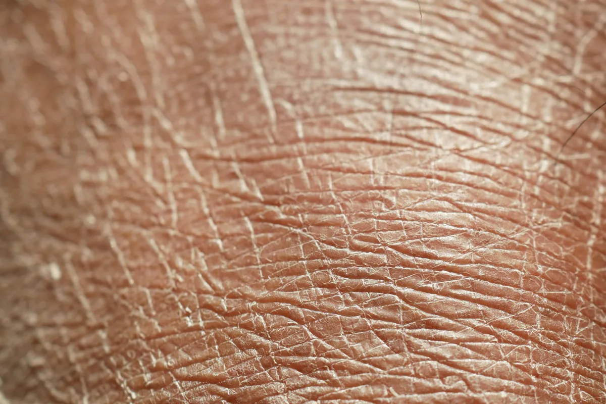 Skin Resurfacing & Uniformização